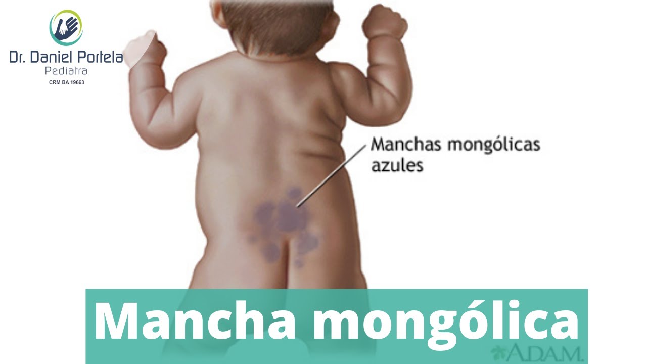 Mancha mongólica