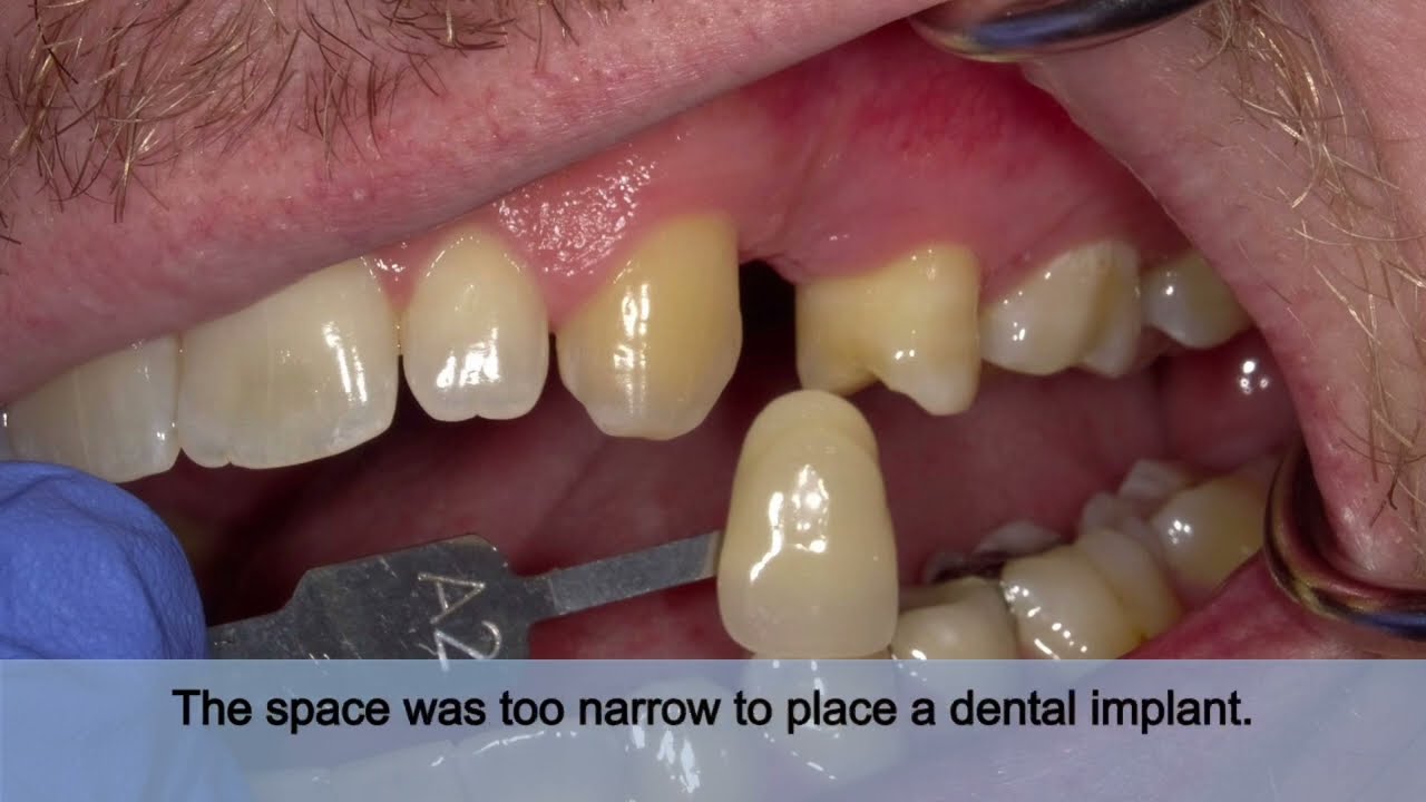 The Missing Tooth- the fixed bridge option