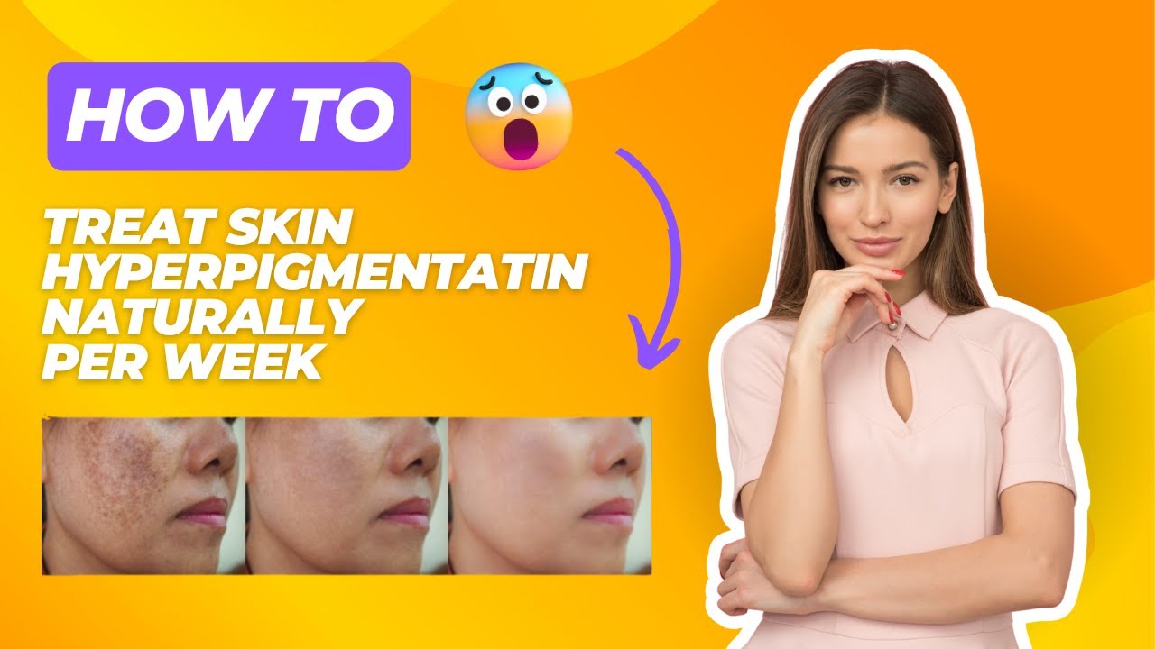 How to Treat Skin Hyperpigmentation Naturally