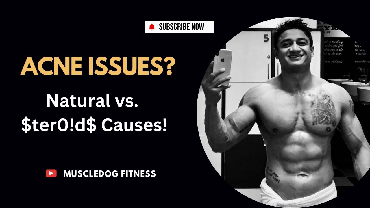 Acne & Steroids: Causes, Prevention & Treatment Explained | in Hindi | Muscledog Fitness