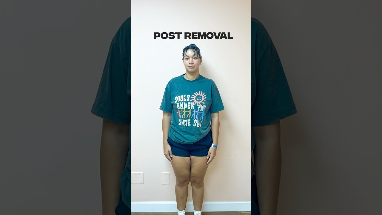 8 months after Gastric Balloon! (-53 lbs)