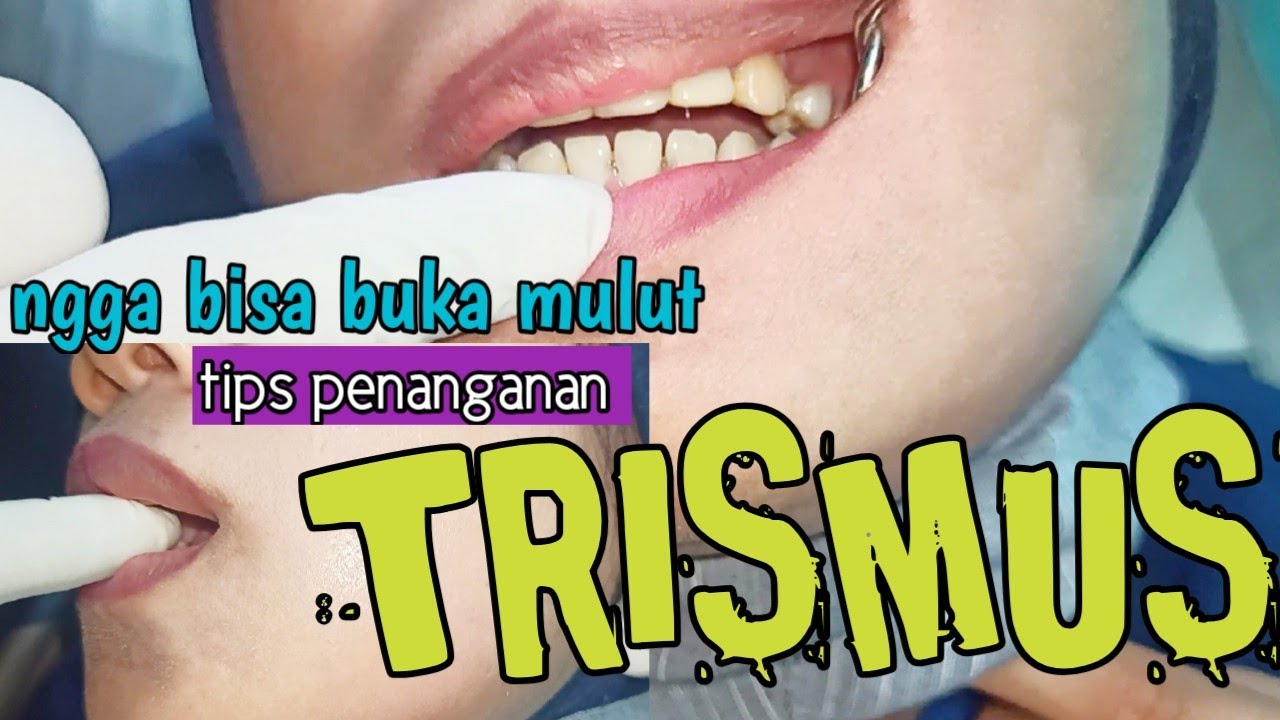 TRISMUS kaku dan kesusahan membuka rahang dan tips penangannya