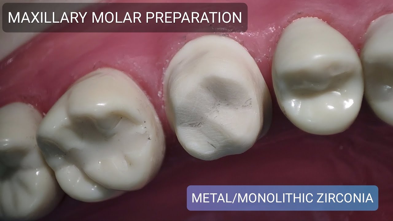 Dr VK's Dental Skool | MAXILLARY MOLAR | TOOTH PREPARATION | ALL METAL AND MONOLITHIC ZIRCONIA