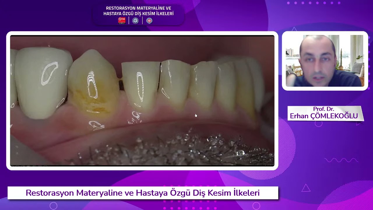 Restorasyon Materyaline ve Hastaya Özgü Diş Kesim İlkeleri