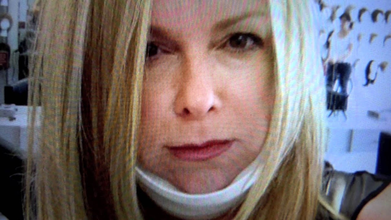 Neck-lift. No down Time, no General anesthesia.