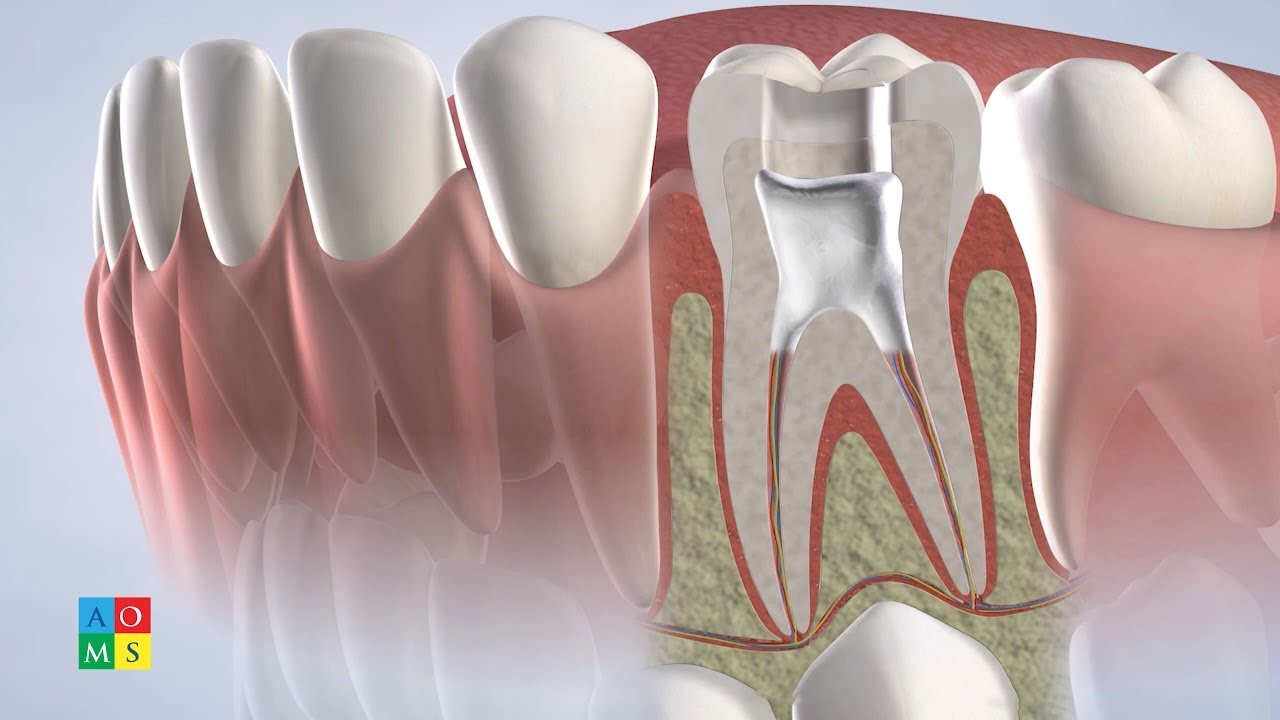 Baby Root Canal in Amarillo TX | AOMS Pediatric & Children's Dentistry