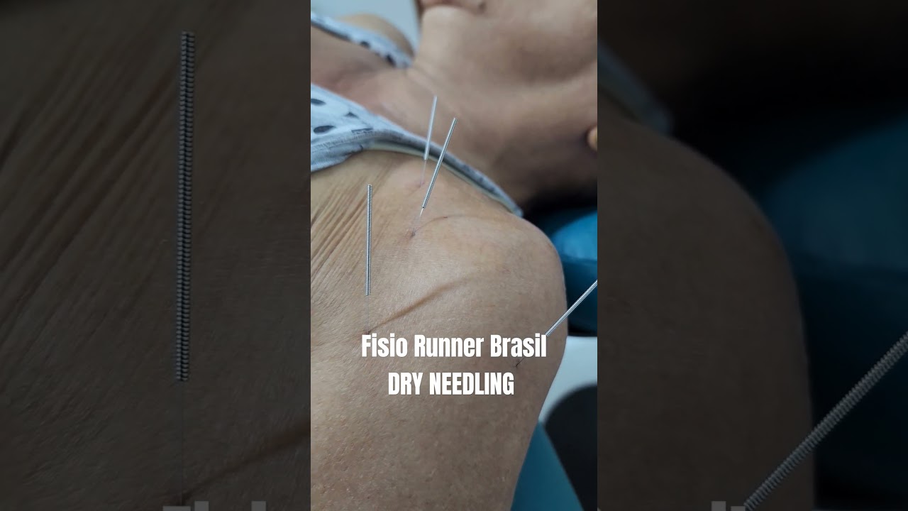 T&eacute;cnica para tirar a dor em 1 sess&atilde;o #fisioterapia #ortopedia #natalrn