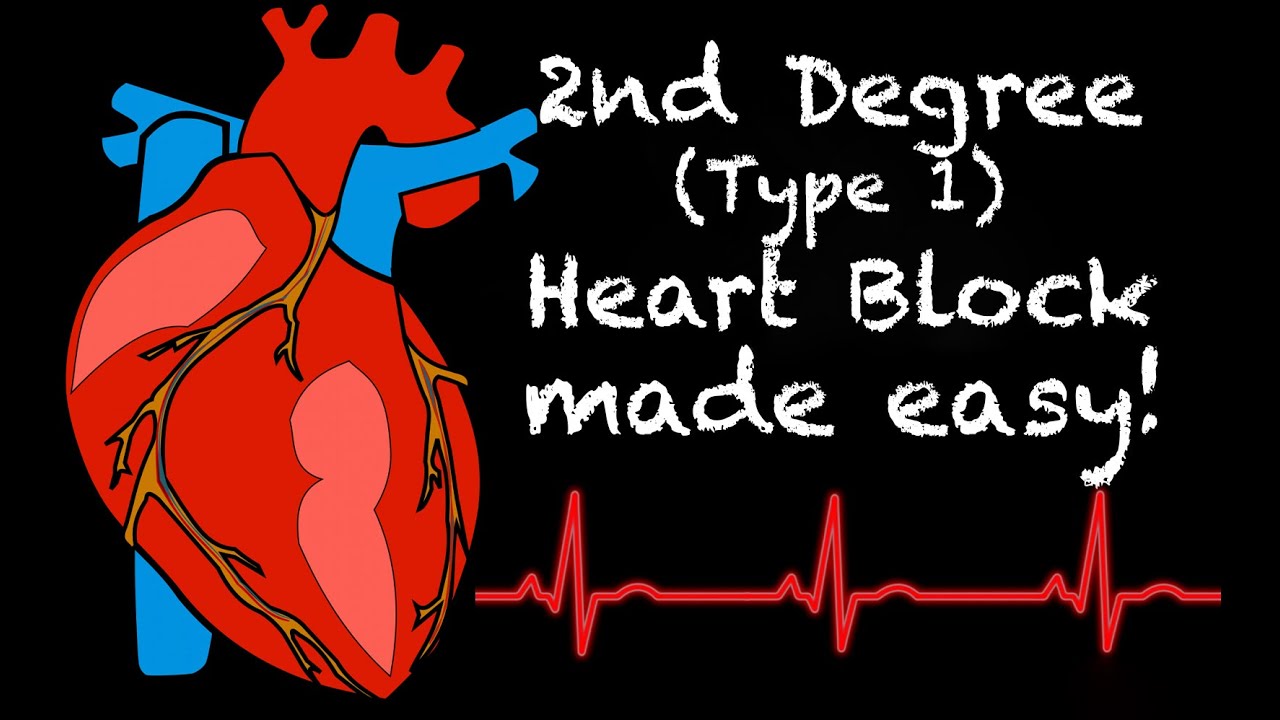EMS Cardiology || Tachy Tuesday: 2nd Degree Type I Heart Block (Wenckebach)