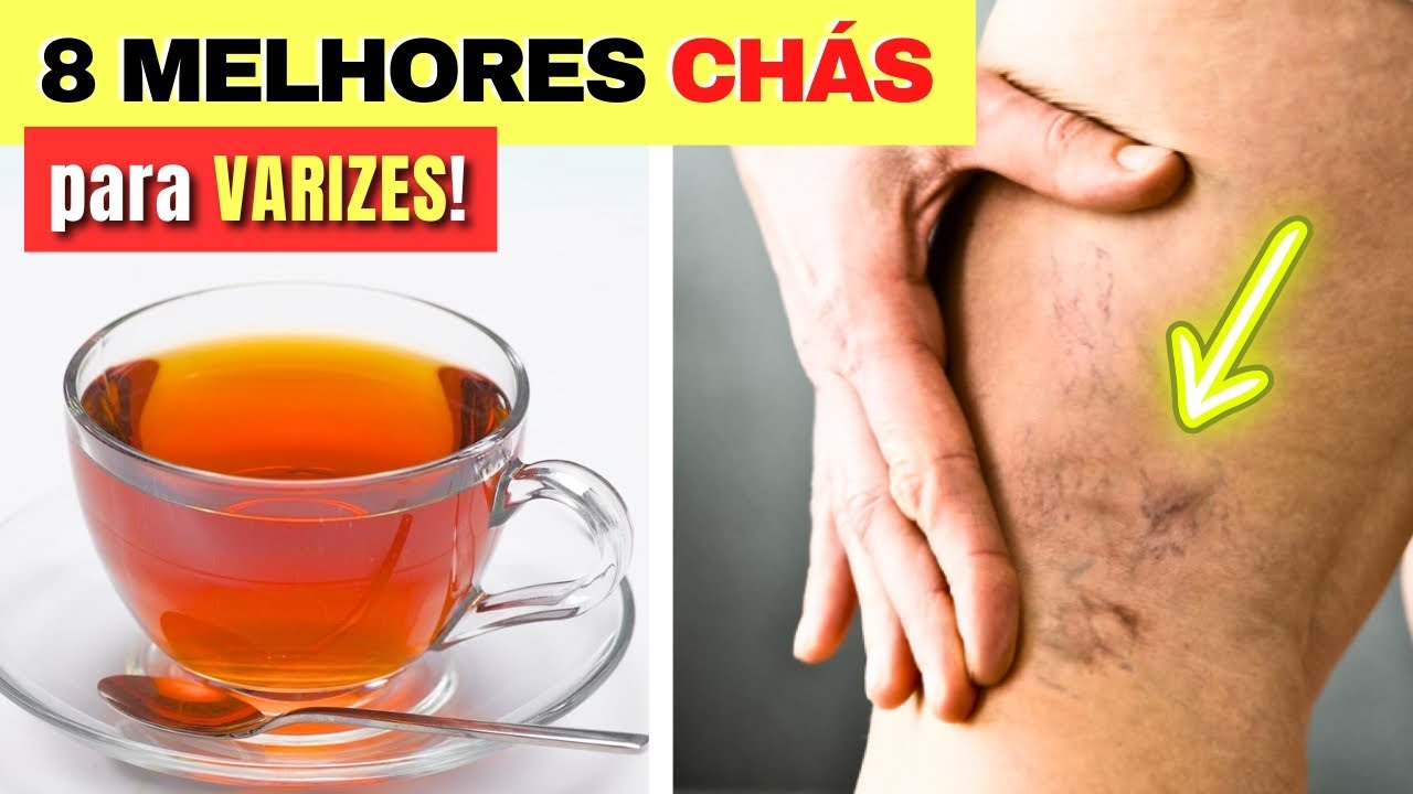 8 Melhores CH&Aacute;S PARA VARIZES - Benef&iacute;cios e Como Usar