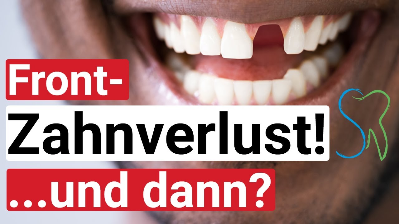 Frontzahnverlust - was tun wenn ein Vorderzahn oder Schneidezahn raus muss oder verloren geht?