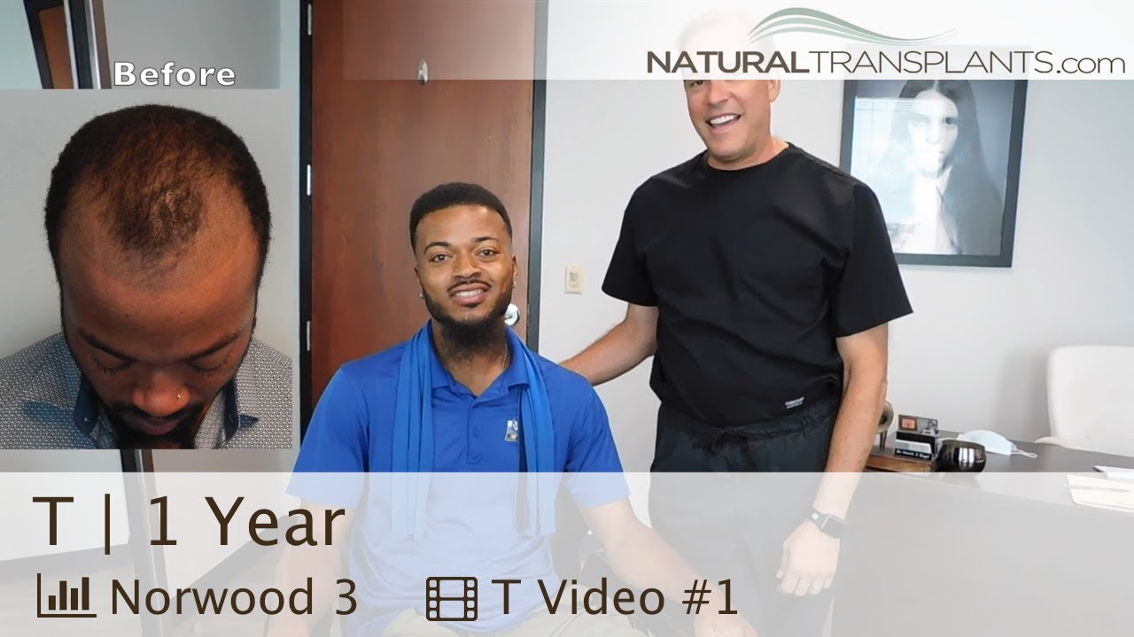 Hair Transplant 1 Year After Hair Transplantation Surgery for Men | Dr. Harold Siegel (T)