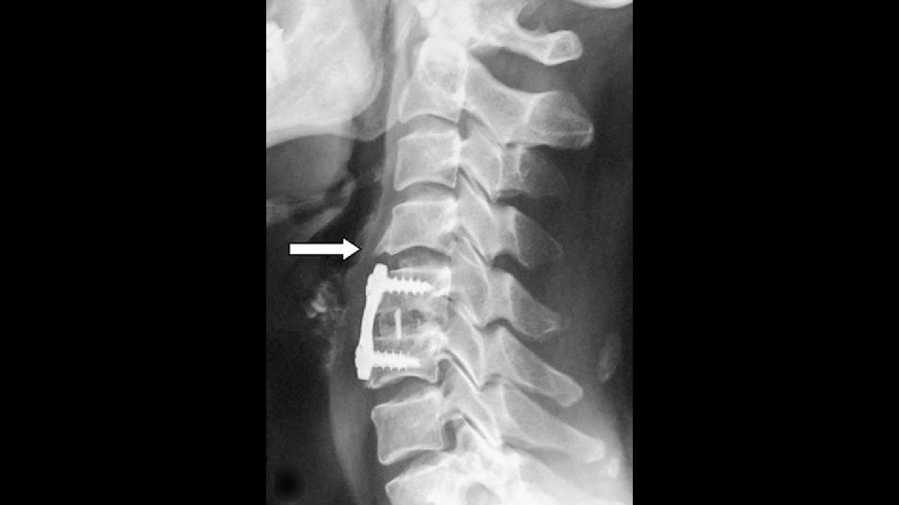 Adjacent Segment Disease and settling your workers compensation case
