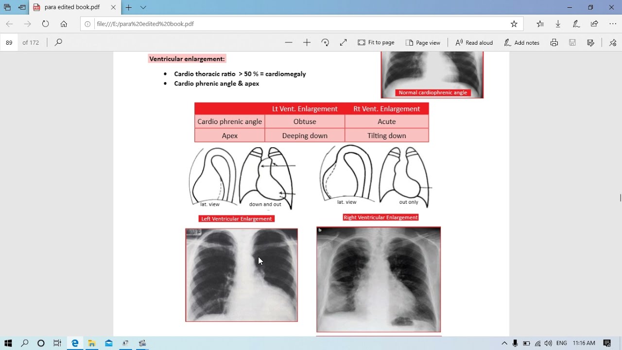 Radiology - 3 Heart x-ray - Dr Mahmoud Allam