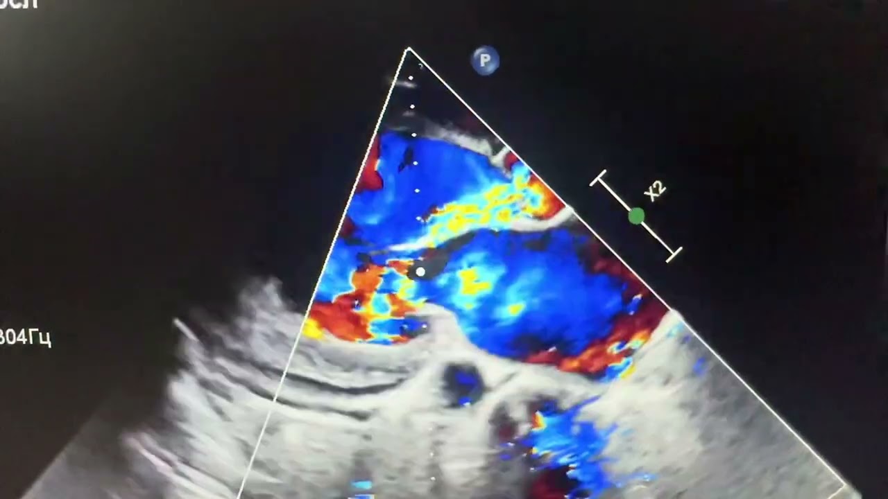 Holodiastolic flow reversal in descending aorta