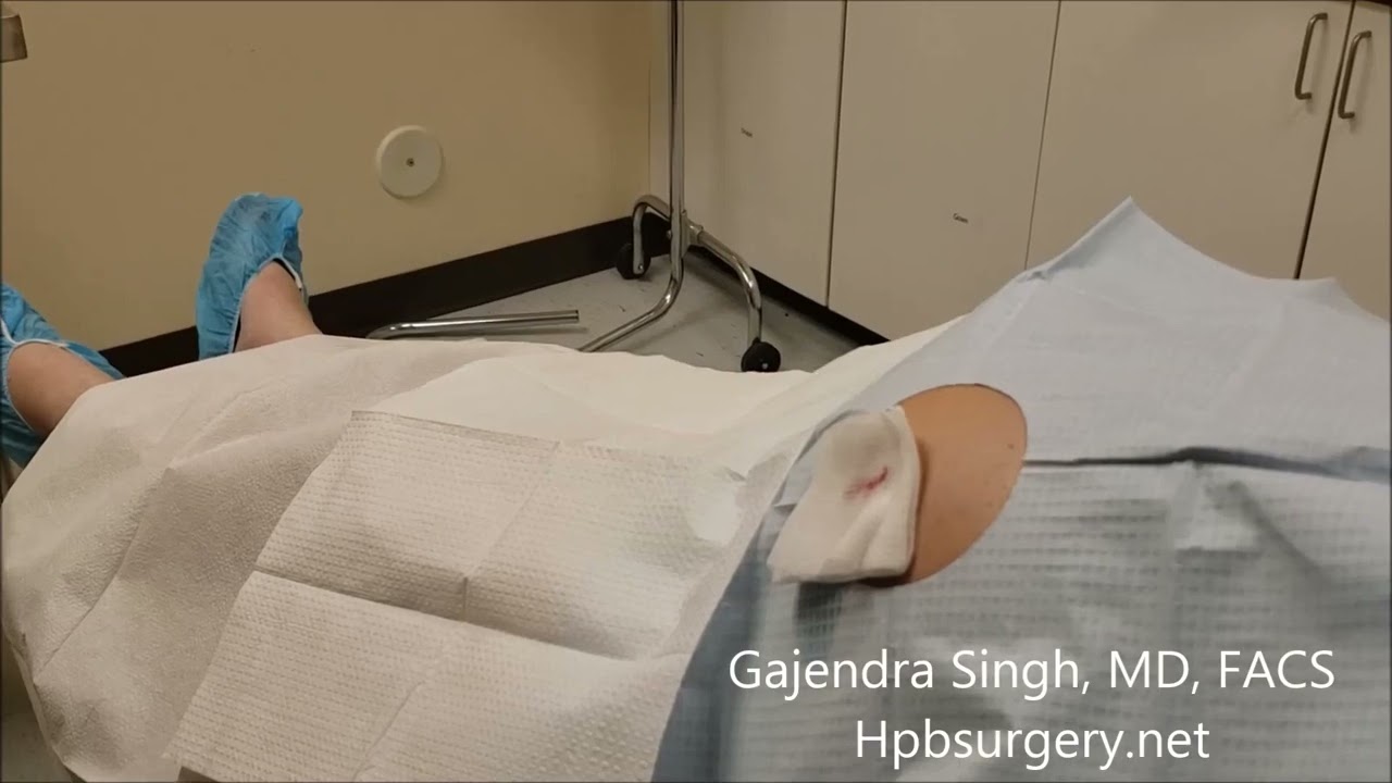 Removal Abdominal Fluid or Ascites  - Paracentesis By Dr. Gajendra Singh