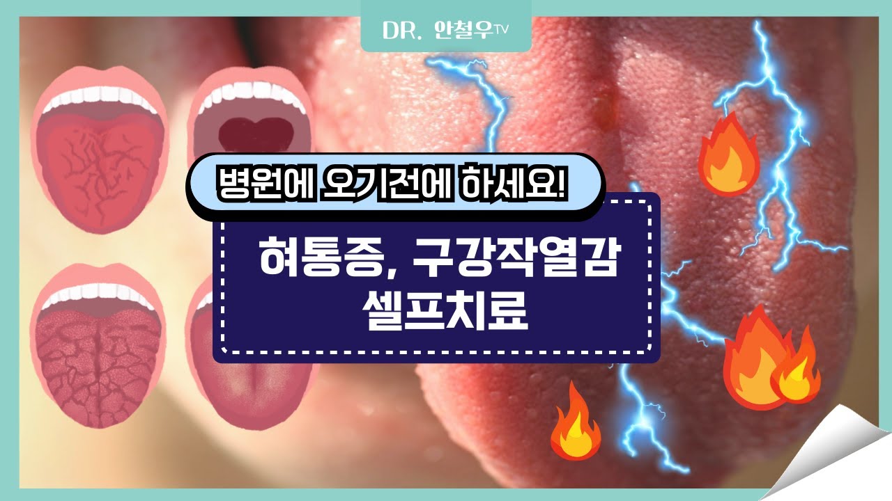 구강작열감증후군 원인과 치료 방법 [입안에서 번개가 치고 불덩이를 문 느낌. 혀가 아픈 원인]