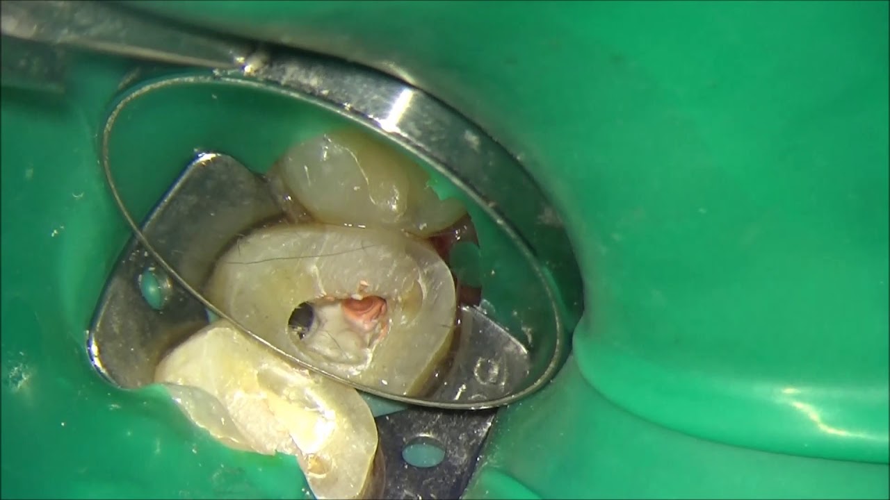 Root Canal Filling : Advantage of Bioceramic Sealer(Vericom Well-root ST) in case of opening problem