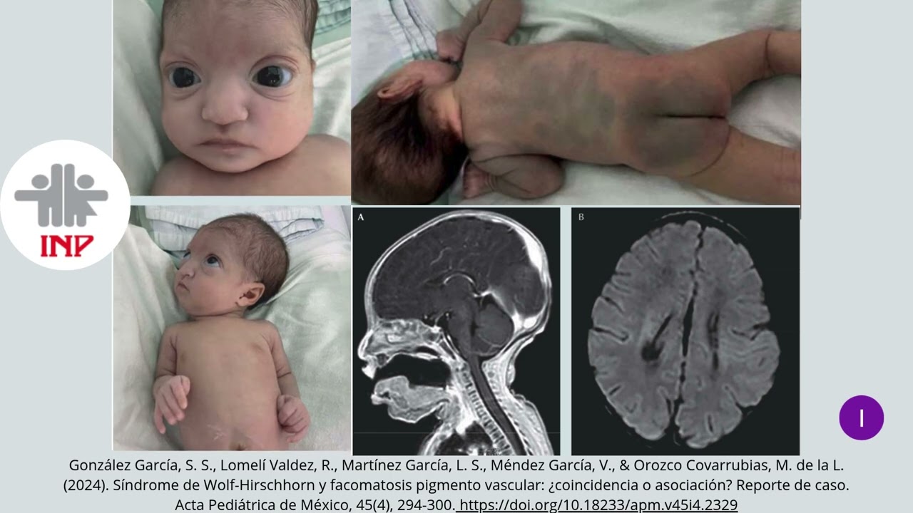 Sindrome de Wolf-Hirschhorn (4p-) por: Santiago Ochoa Isabella 2221