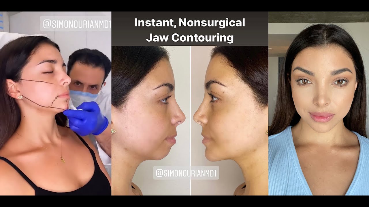 JAWLINE AND CHIN CONTOUR WITH FILLER | BEFORE AND AFTER |  Dr. SimonOurian