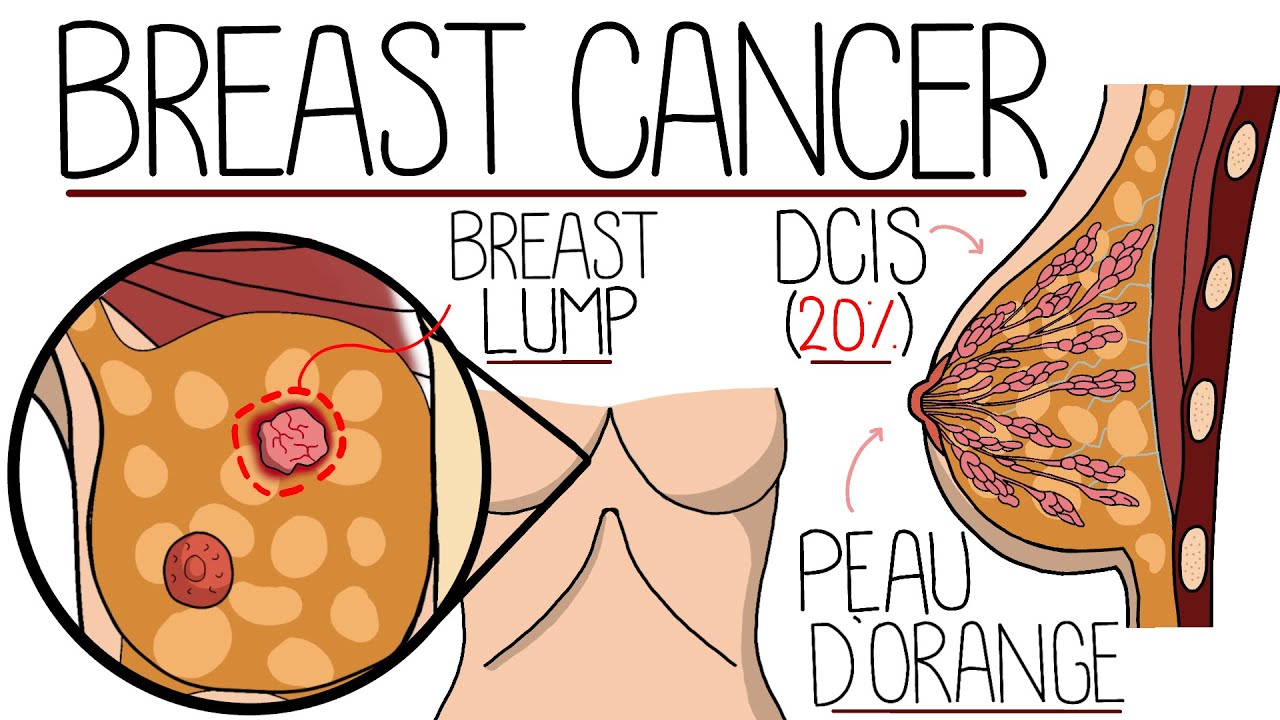 Understanding Breast Cancer (Including Symptoms & Treatment)