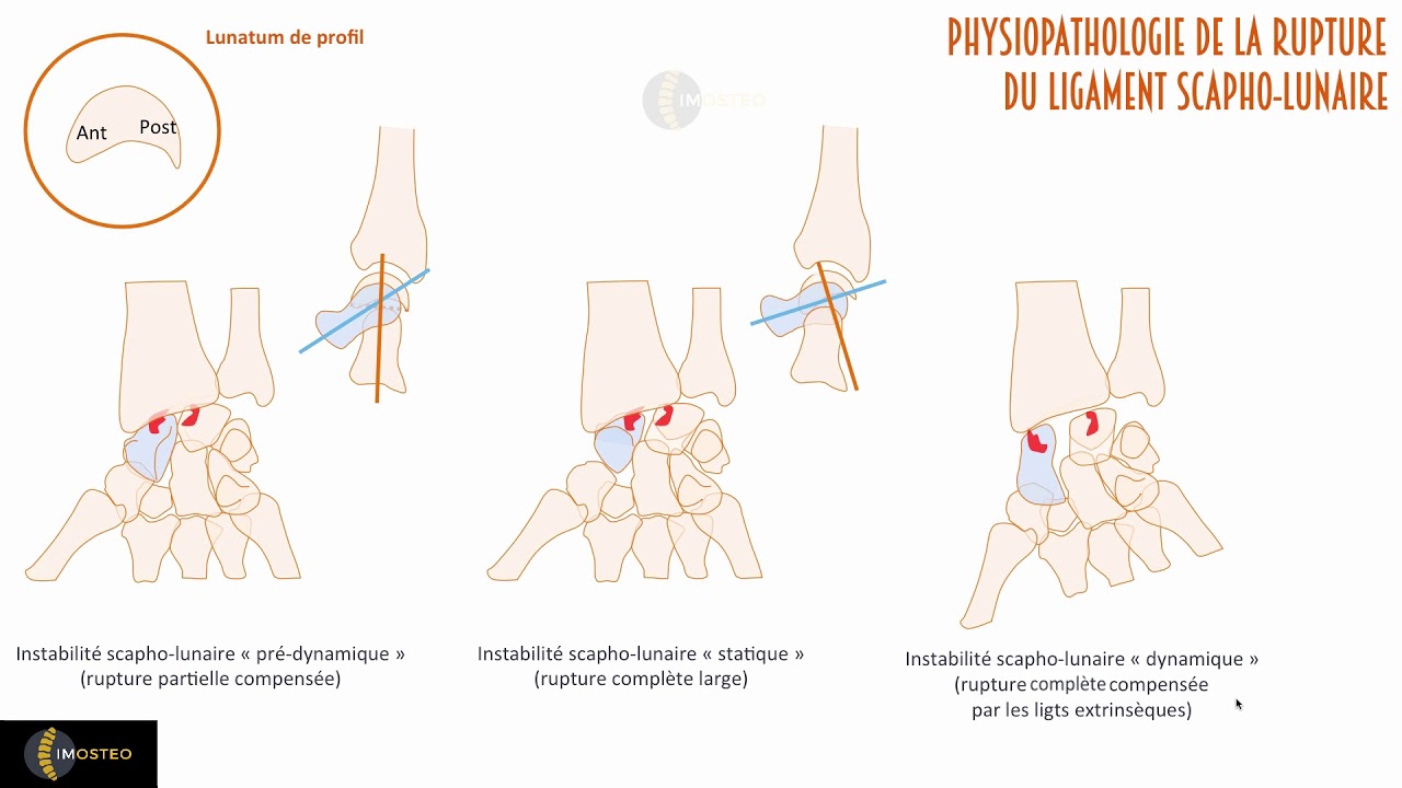 Tutoriel IMOSTEO #6 : physiopathologie et sémiologie radiologique de l'instabilité scapho-lunaire