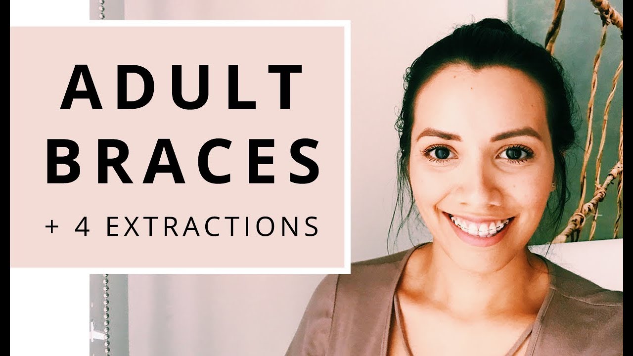 Adult braces AFTER 4 extractions | 3 month braces progress