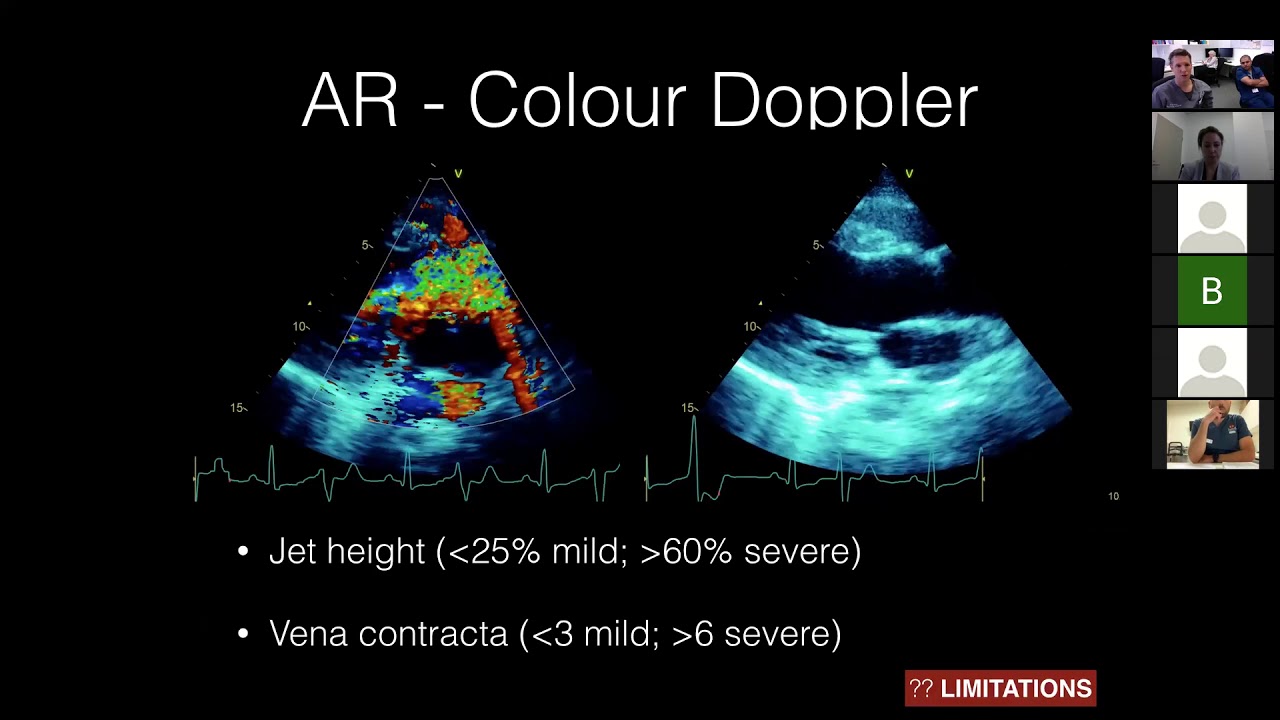 Aortic Regurgitation