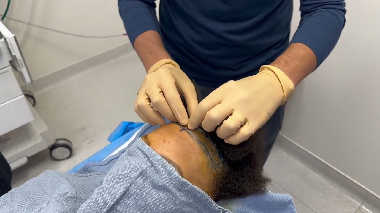 Patient for hairline lowering/forehead reduction surgery