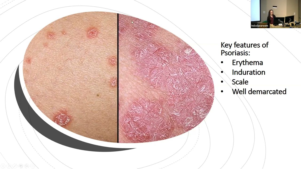 3/3/2023: The Road to Prevention of Psoriatic Arthritis