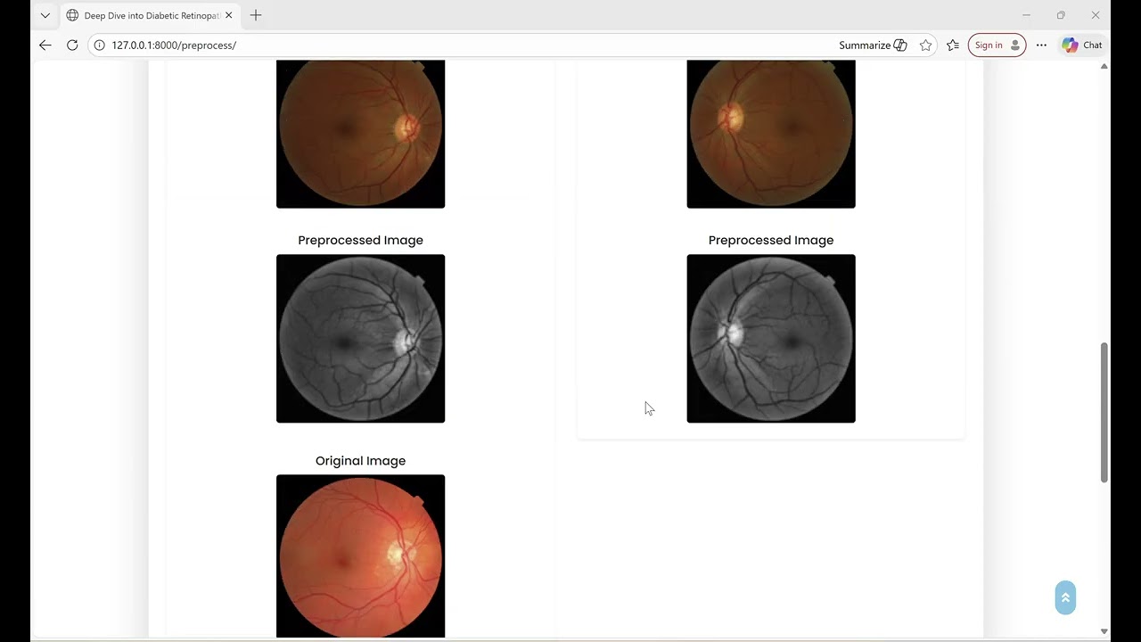 Deep Dive into Diabetic Retinopathy Identification A Deep Learning Approach with Blood Vessel Sgmntn