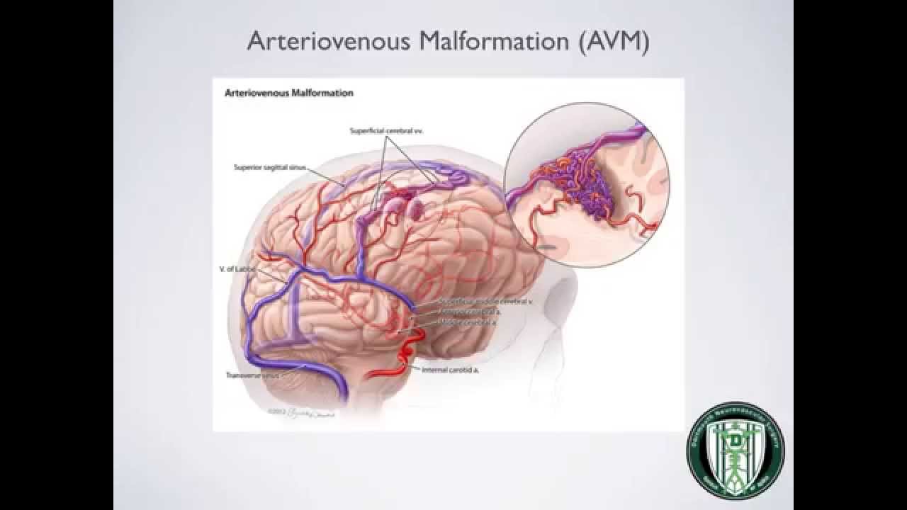 CTH Arteriovenous Malformation (AVM)