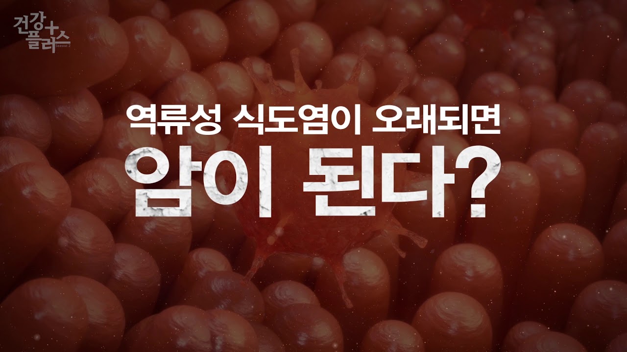 위식도역류질환에 관한 오해와 진실ㅣ건강플러스