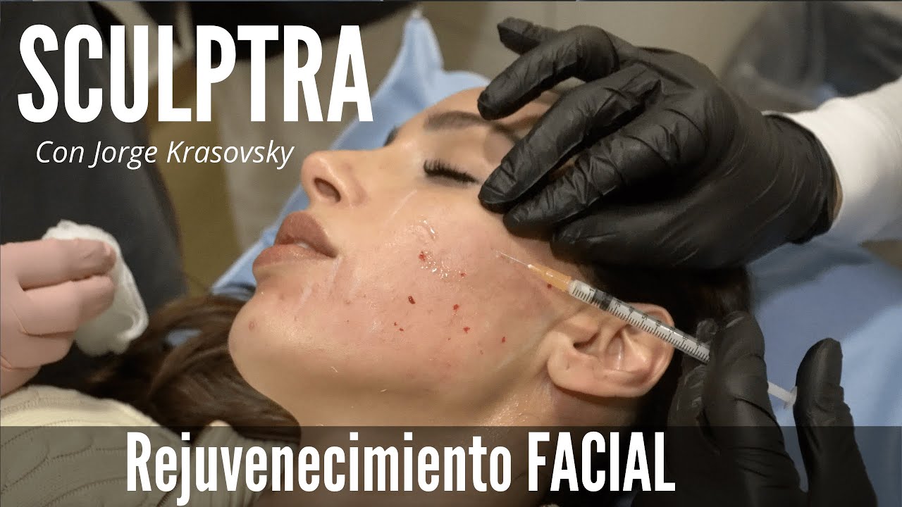 SCULPTRA (Antes y Después) - Lo último en Rejuvenecimiento Facial con el Dr. Jorge Krasovsky
