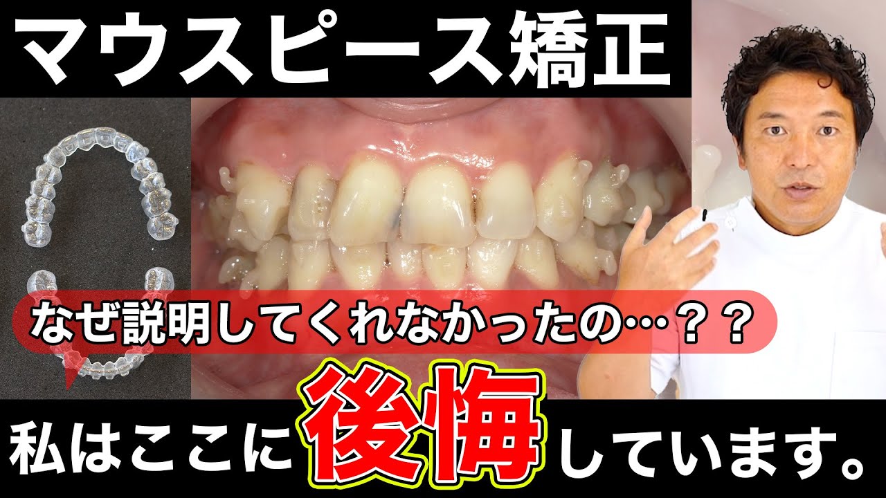 実際に【マウスピース矯正で後悔したポイント】