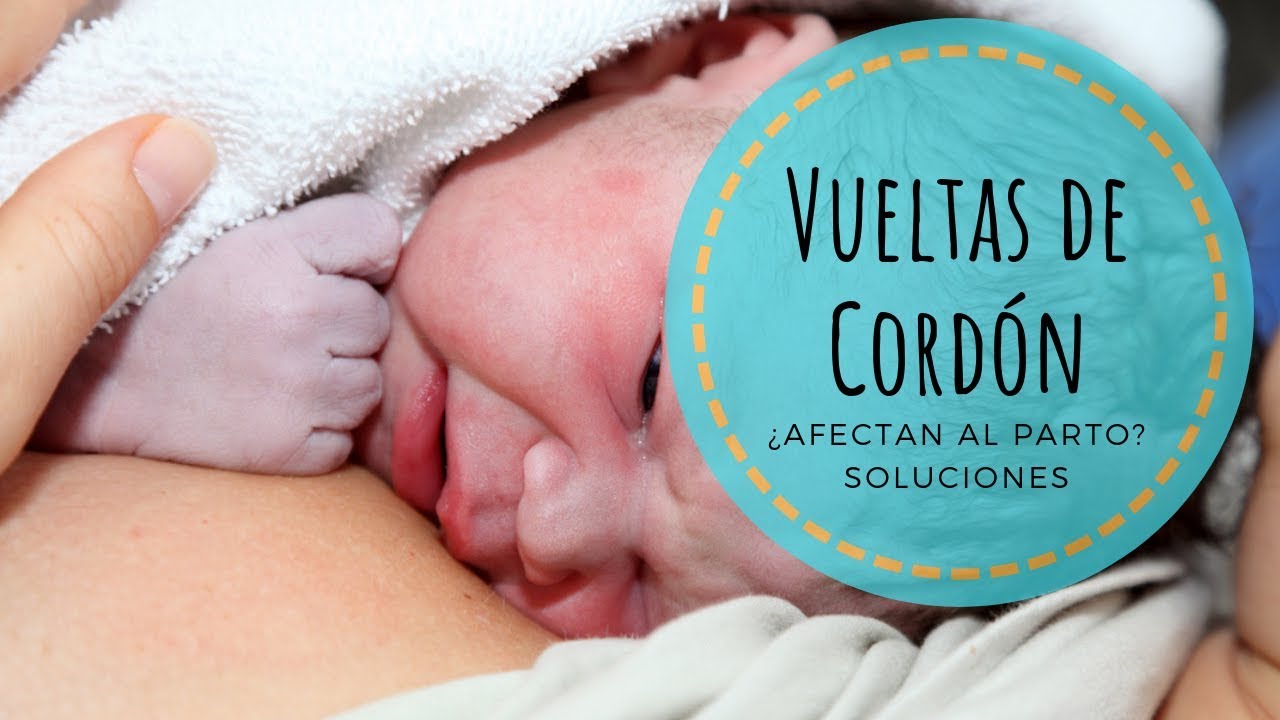 VUELTAS de CORDÓN UMBILICAL en el PARTO · ¿Afectan al parto? + soluciones