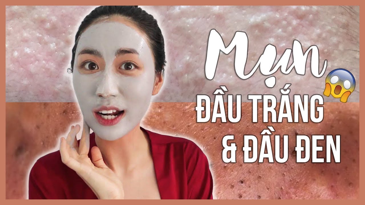 SKINCARE CHO MỤN ĐẦU ĐEN & TRẮNG!!! THANH LÝ MỤN SERIES