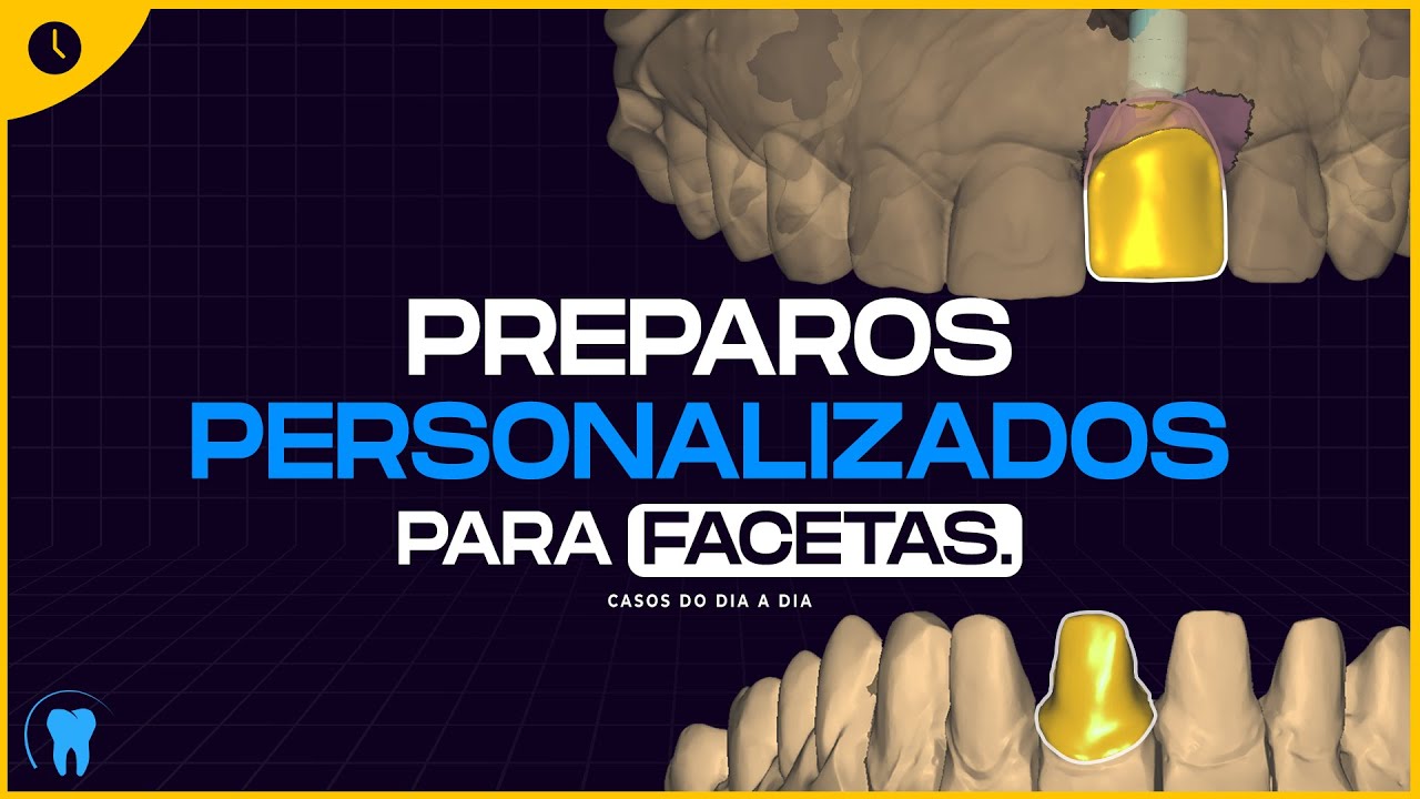 EXOCAD : Duas formas de projetar preparos para facetas para equalização de substratos.