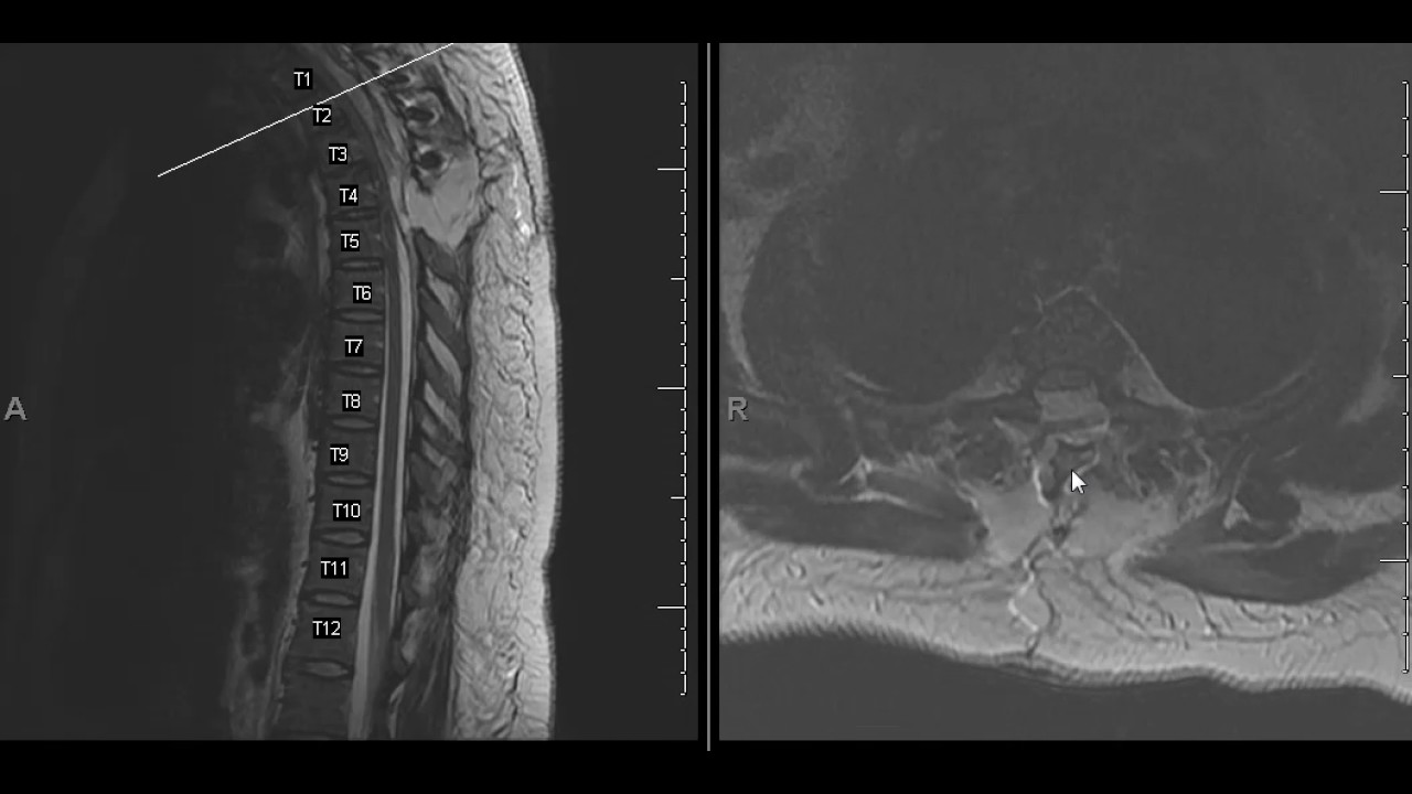 Spinal arachnoid cyst/meningeal cyst