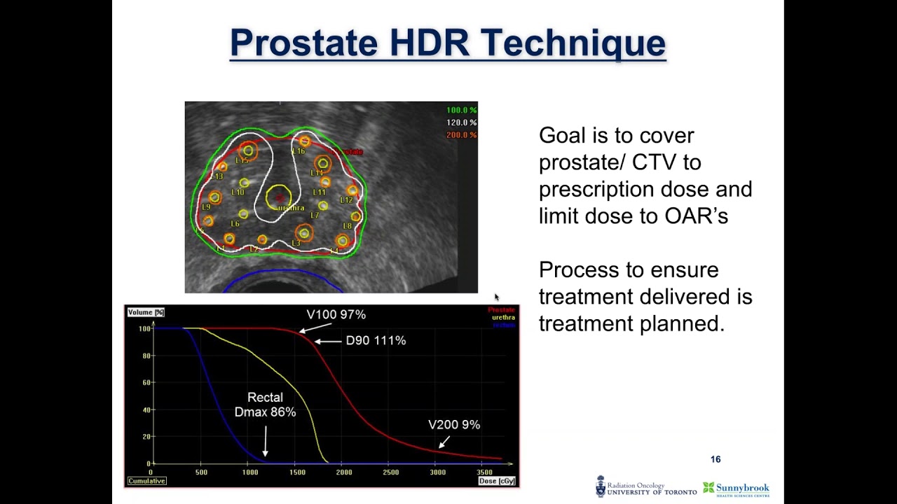 2017 11 21 17 30 HDR prostate brachytherapy technique