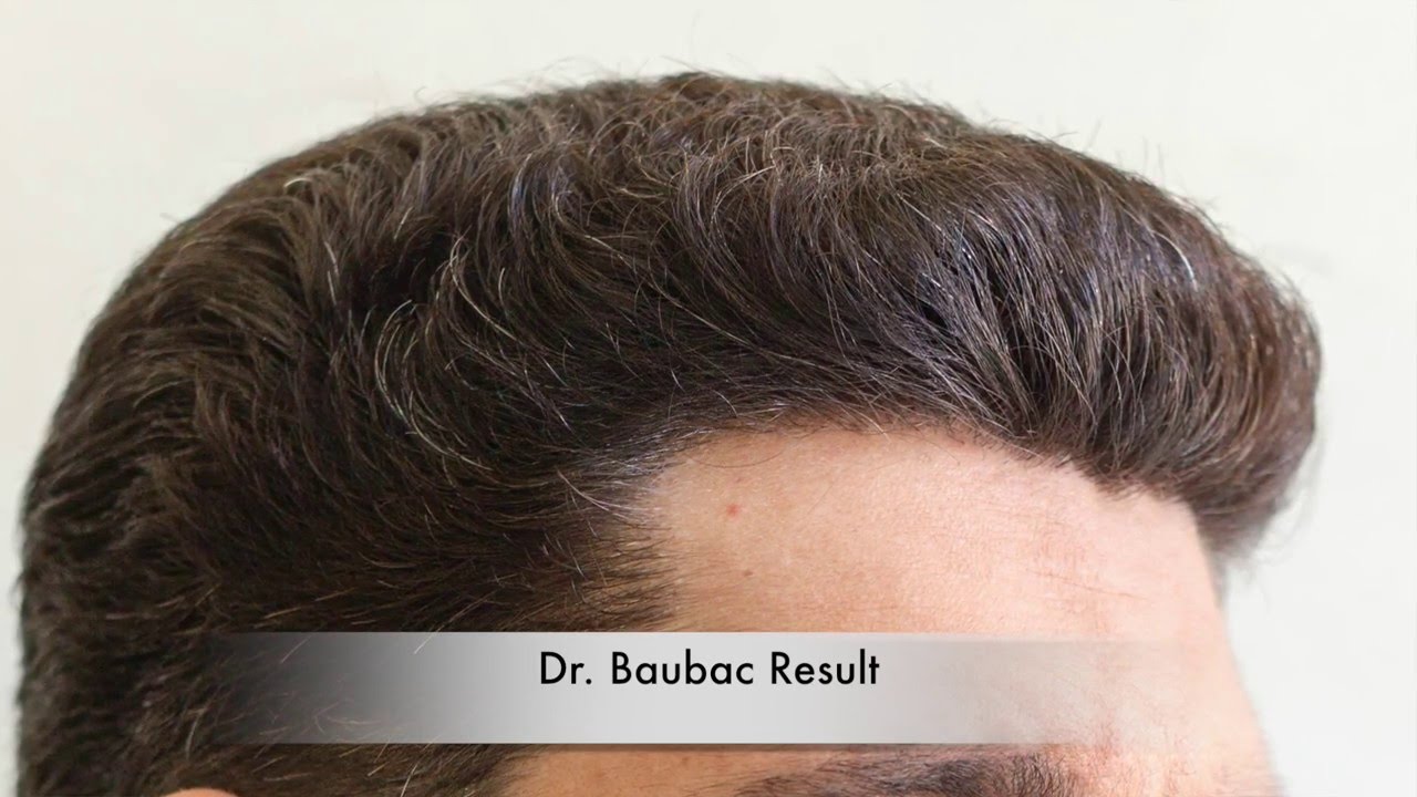 Best Hair Restoration Clinic in Los Angeles – Alvi Armani Beverly Hills