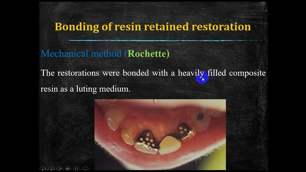 Resin-bonded Restoration