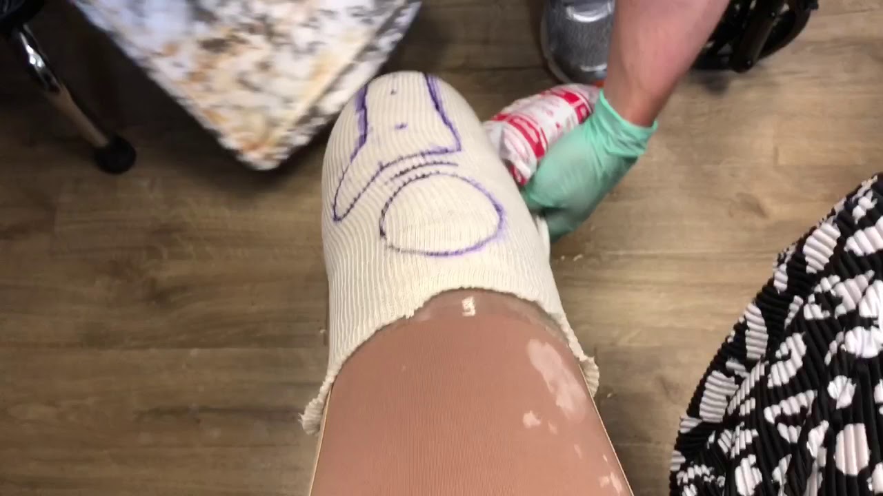 Casting for Prosthesis
