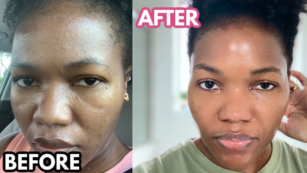 Tretinoin: How I use it For A Flawless Uniform Dark Skin (STOP ACNE)-Dry/Mature/Oily/Sensitive Skin