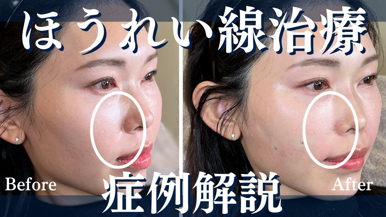 ヒアルロン酸注入でのほうれい線治療【4つの症例をご紹介！】
