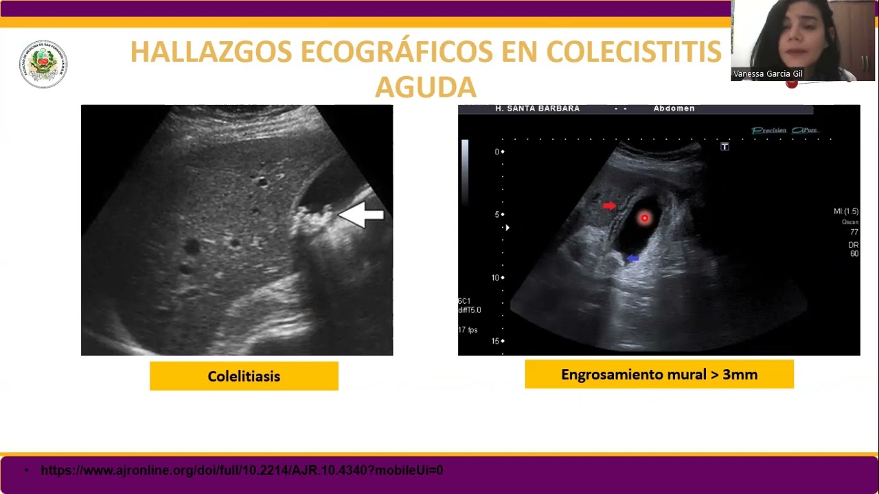 Colecistitis aguda en ecografía