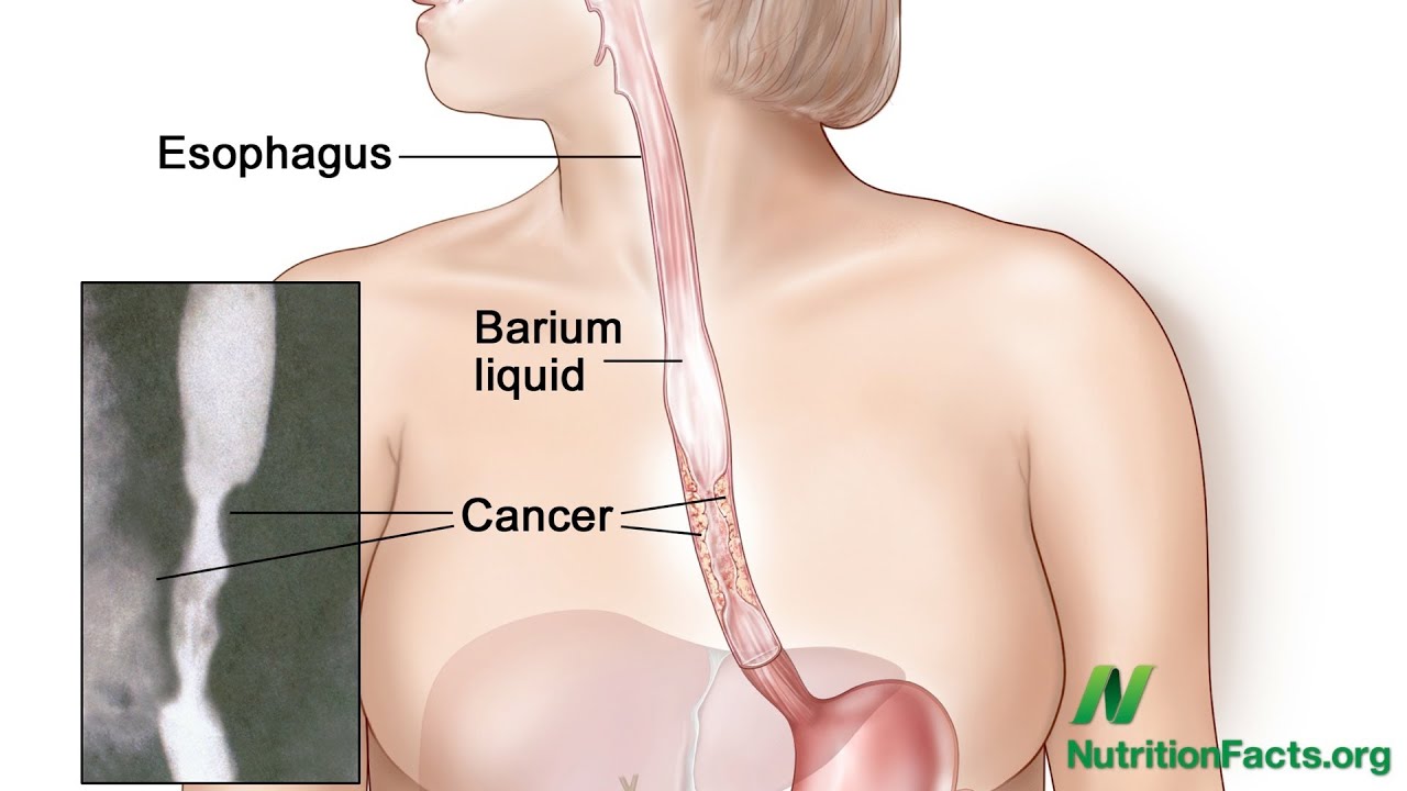 Strawberries versus Esophageal Cancer