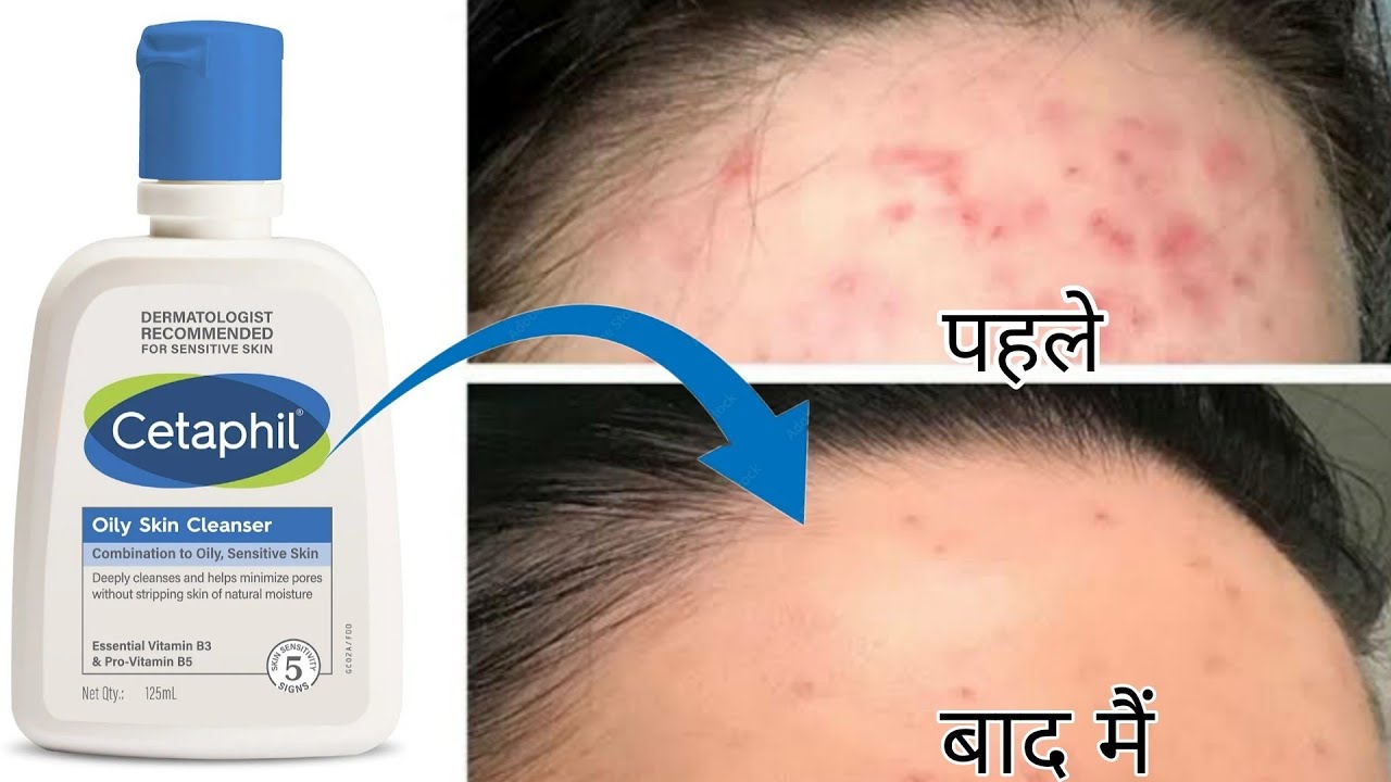 Dr Recommended Best Face Wash For oily acne pimple prone skin|cetaphil face wash remove acne|pimples