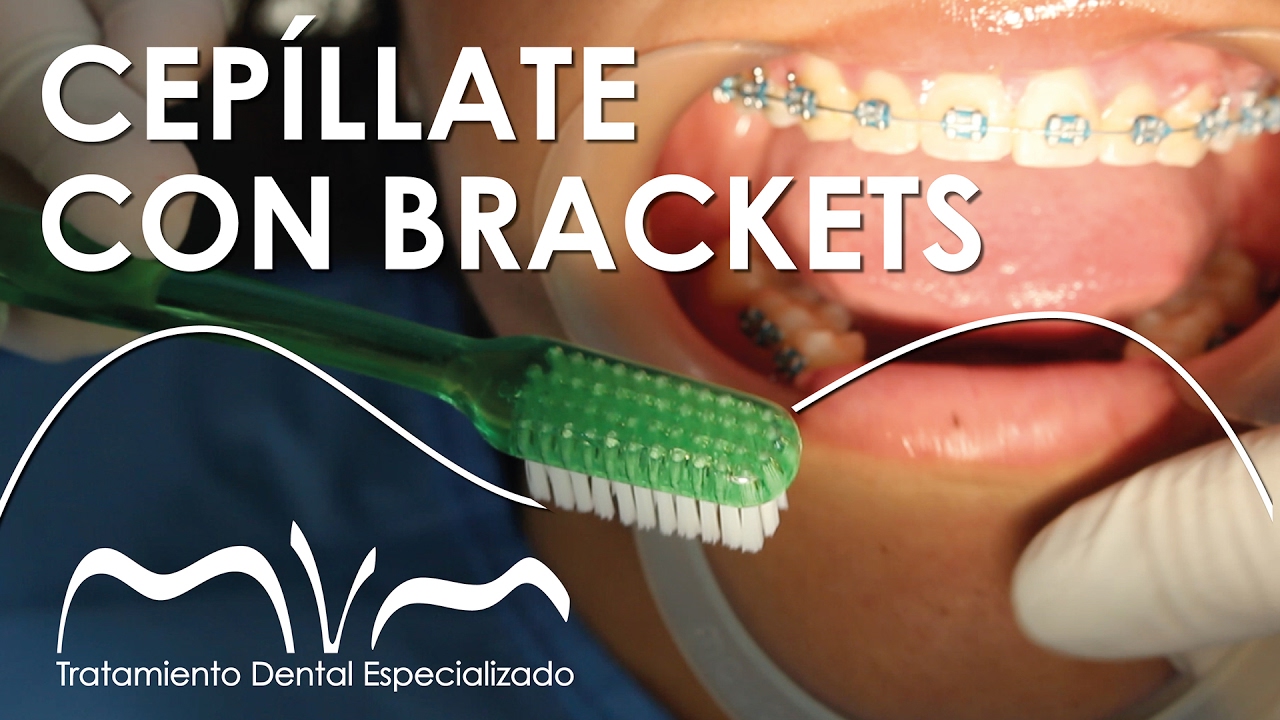 CEPÍLLATE LOS DIENTES CON BRACKETS  ¡ APRENDE YA! | Cepillado con Brackets vestibulares