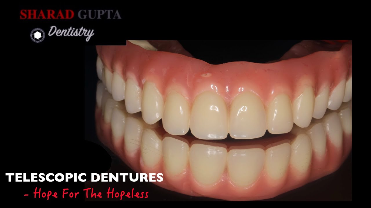 TELESCOPIC DENTURE