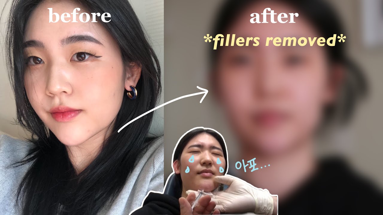 턱끝 필러 녹인 썰 푼다.mov/필러 녹인 후기/턱끝필러/why i got my chin filler removed